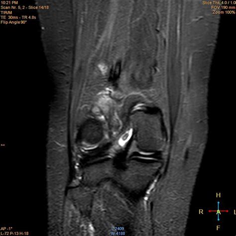 Parosteal Osteosarcoma Image Radiopaedia Org