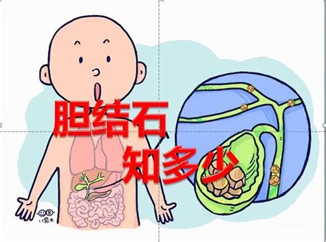 「膽結石」知多少！你真的有了解過「膽結石」嗎？ 每日頭條