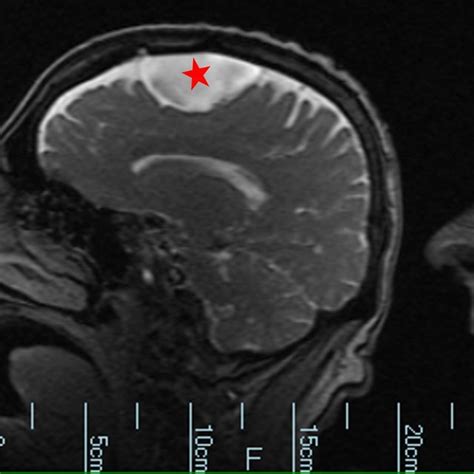 Computed Tomography Showing Arachnoid Cyst Of The Left Frontal Lobe Download Scientific