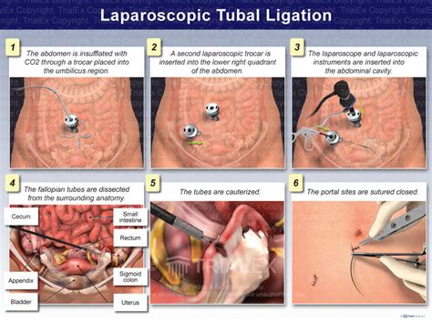 Laparoscopic Tubal Ligation Trialquest Inc