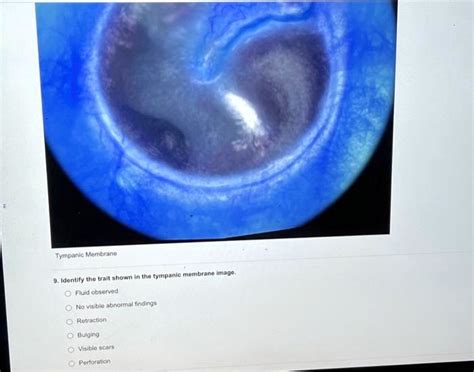 9 Identify The Trait Shown In The Tympanic Membrane Image Fluid Observed No Visible