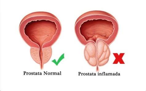 Crecimiento prostático hiperplasia de la próstata agrandamiento de la