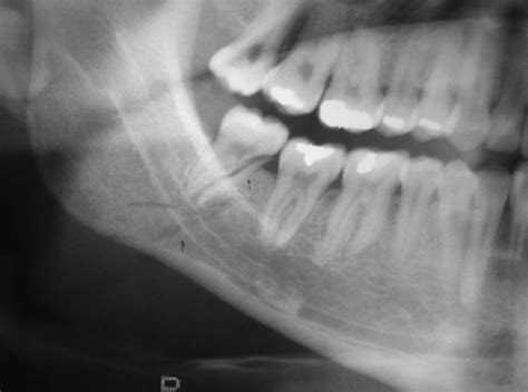 Mandibular Angle Fracture With Fractured Third Molar Patient