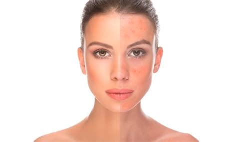 How To Control Rosacea Laser Therapy Treatments In Vancouver Bc