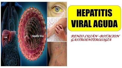 Hepatitis Viral Aguda Y Cronica Renzo Luj N Udocz