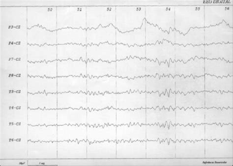 EEG digital ondas agudas em áreas temporais à esquerda Download