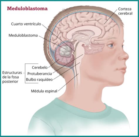 Meduloblastoma Neurocirugia Infantil