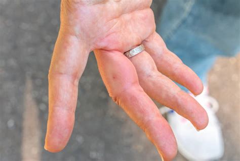 Bee Sting On Finger Stock Photos Pictures And Royalty Free Images Istock