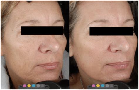 Coolpeel Laser Austin Tx Skin Science Soul By Dr Sholar