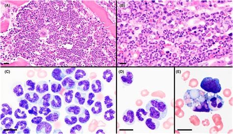 Bone Marrow Core Biopsy A And B And Aspirate C‐e Specimens Showing