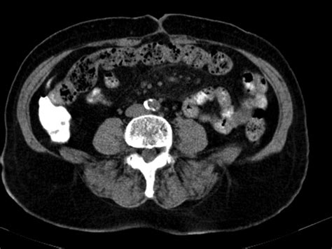 Mesenteric Panniculitis Diagnostic Precision Bmj Case Reports