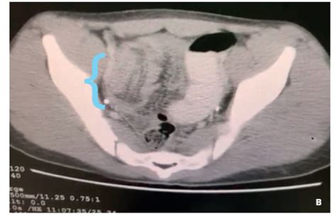 Invaginaci N Ileoileal Por P Lipo Intestinal En Un Ni O De A Os