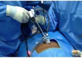 Single Incision Laparoscopic Surgery Sils System Provides Surgeons