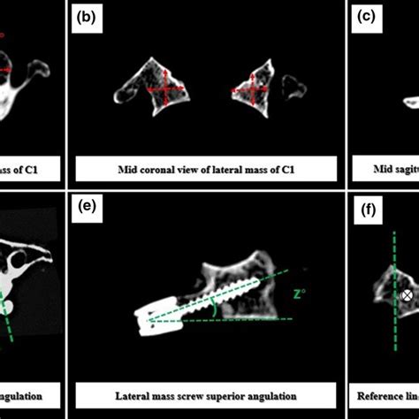 Atlas Lateral Mass Screw Placement Technique A Posterior Arch Of C B