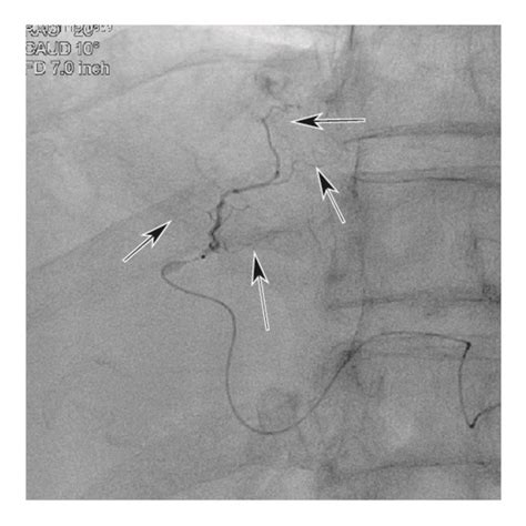 Right Hepatic Duct Stricture Complicating Raib Tace In A Download Scientific Diagram