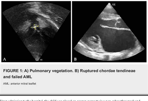 Figure 1 From Chordae Tendinea Rupture And Pulmonary Valve Vegetation