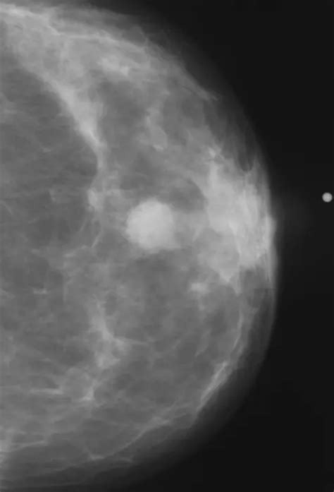 Abnormal Mammogram Image Eurekalert Science News Releases