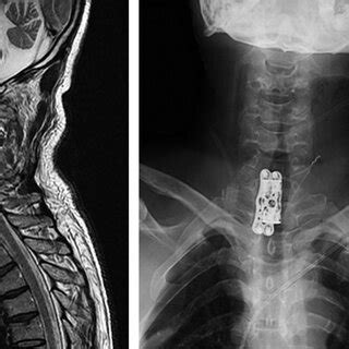 Case Year Old Man With C Fracture Vertical Compression Injury