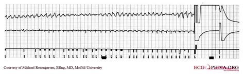 Ventricular fibrillation EKG examples - wikidoc