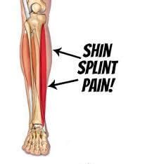 Shin Splint - HealthnPhysio