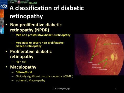 Diabetic Macular Edema Pathophysiology