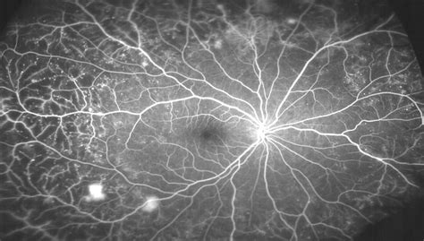 Pruebas diagnósticas Angiografia fluoresceinica IMO