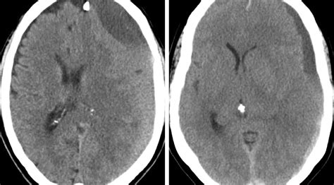 Chronicsubacute Subdural Hematoma The Neurosurgical Atlas By Aaron Cohen Gadol Md