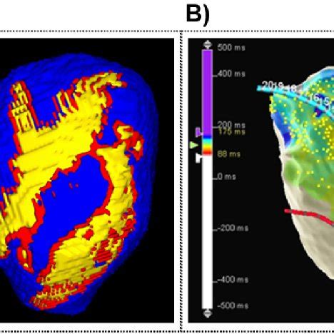 Experimental Data A Example Of Lge Mri Showing The Lv Rv And The