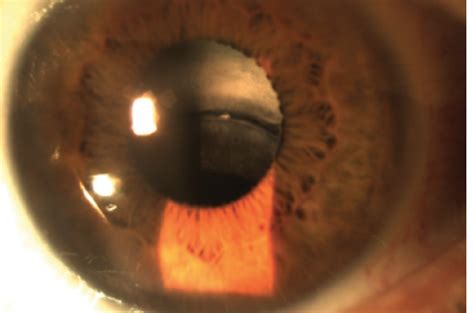 CRSToday | Monocular Diplopia 15 Years After Surgery