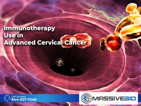 Immunotherapy Use in Advanced Cervical Cancer - Massive Bio