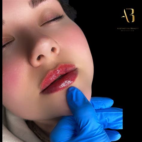 Lip Filler North London Artofit