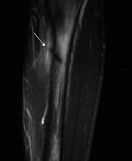 Tibial Stress Fracture-MRI - Sumer's Radiology Blog