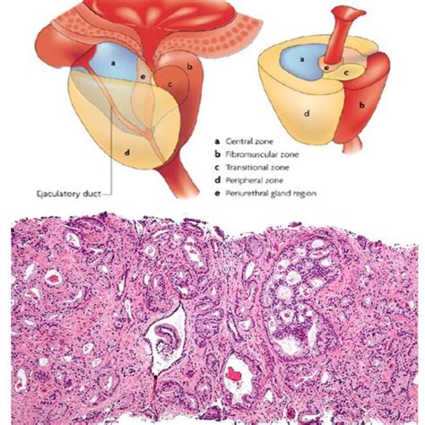 Shown Is The Original Gleason Grading System The Figure Shows Patterns