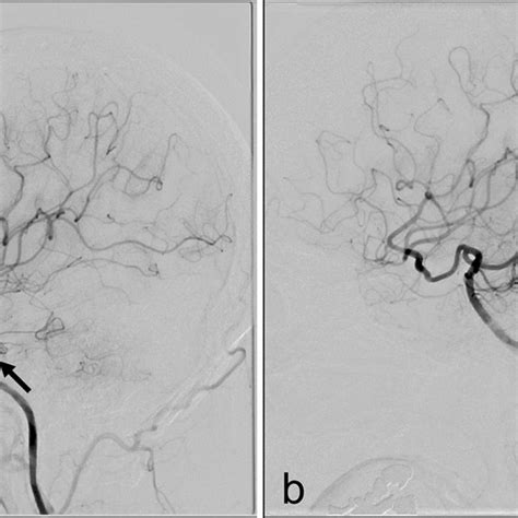 Left Internal Carotid Angiogram A Lateral View Revealed Hypoplasia Of