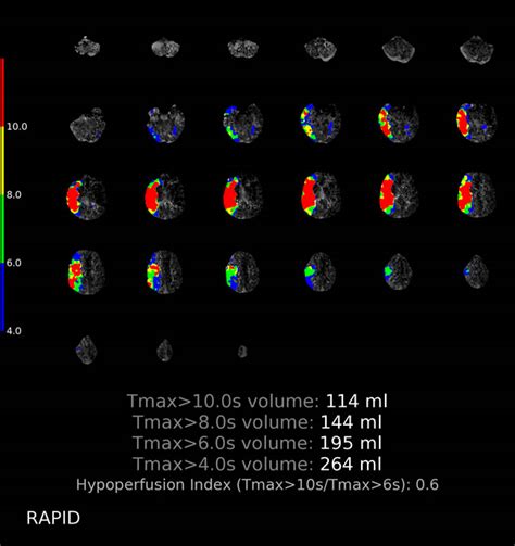 L Mca Infarct