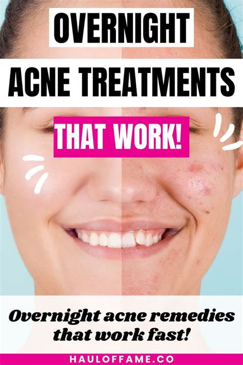 Top Best Overnight Acne Spot Treatments Artofit