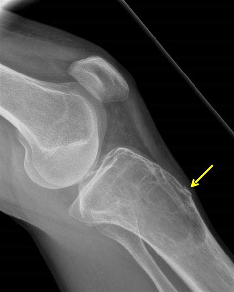 Aneursymal bone cyst – Radiology Cases