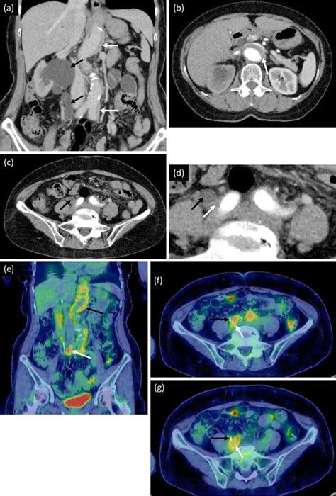 Figure1itial Contrast Enhanced Computed Tomography Scan After Download Scientific Diagram