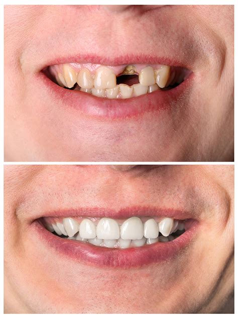 Before-and-after-of-a-incisive-tooth-restoration-treatment - Wisconsin ...