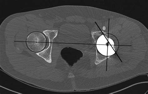 Evaluation Of Version Of Acetabular Component Following Total Hip