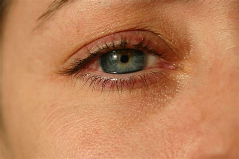 Conjuntivitis Alérgica Síntomas Y Tratamiento Novovisión