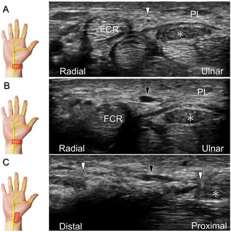 Diagnostics Free Full Text Ultrasound Imaging And Guidance For Distal Peripheral Nerve