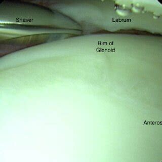 With the patient in the lateral decubitus position, viewing the left ...