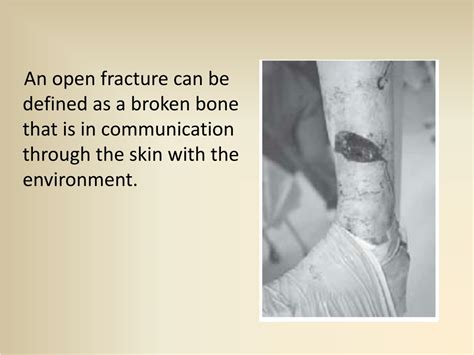 PPT - OPEN (COMPOUND) FRACTURES PowerPoint Presentation, free download