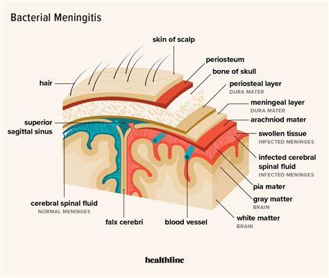 Meningitis: Symptoms, Causes, Types, Treatment, Risks, Vaccine