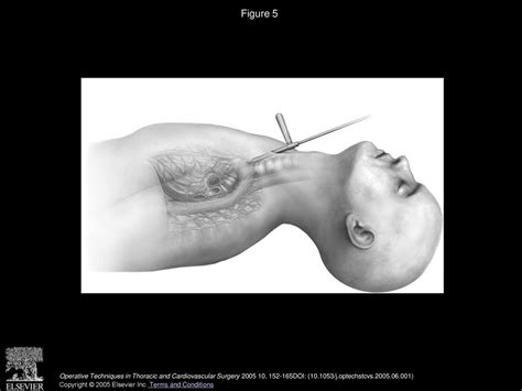 Mediastinal Staging Prior To Surgical Resection Ppt Download