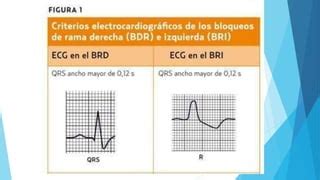 Bloqueo De Rama Izqueirda Y Derecha Electros Ppt