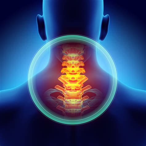 Cervical Facet Pain - Physicians Pain Services