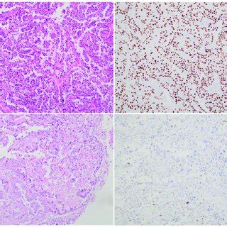 Depiction of Endometrial Clear Cell Carcinoma. The two panels on the ...