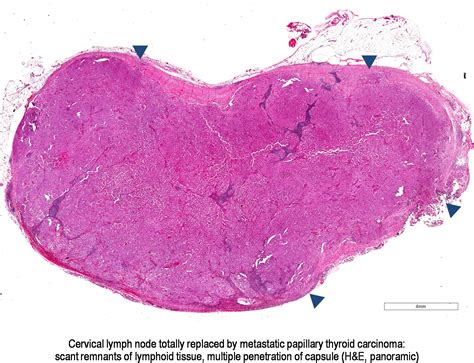 Pathology Outlines Papillary Thyroid Carcinoma Overview